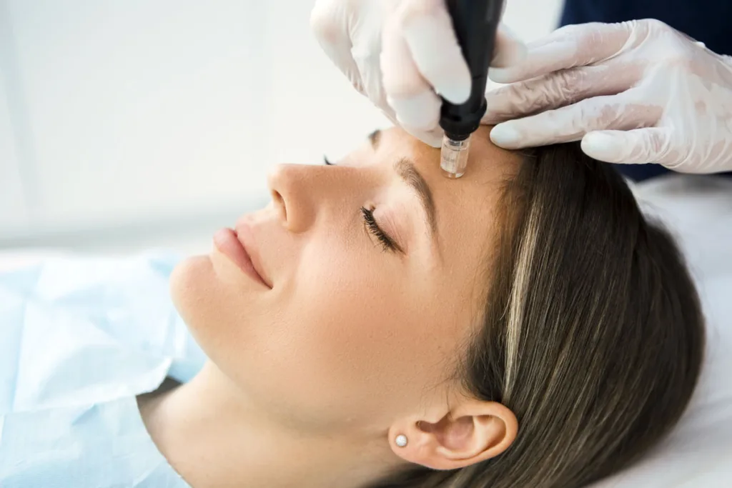 microneedle treatment