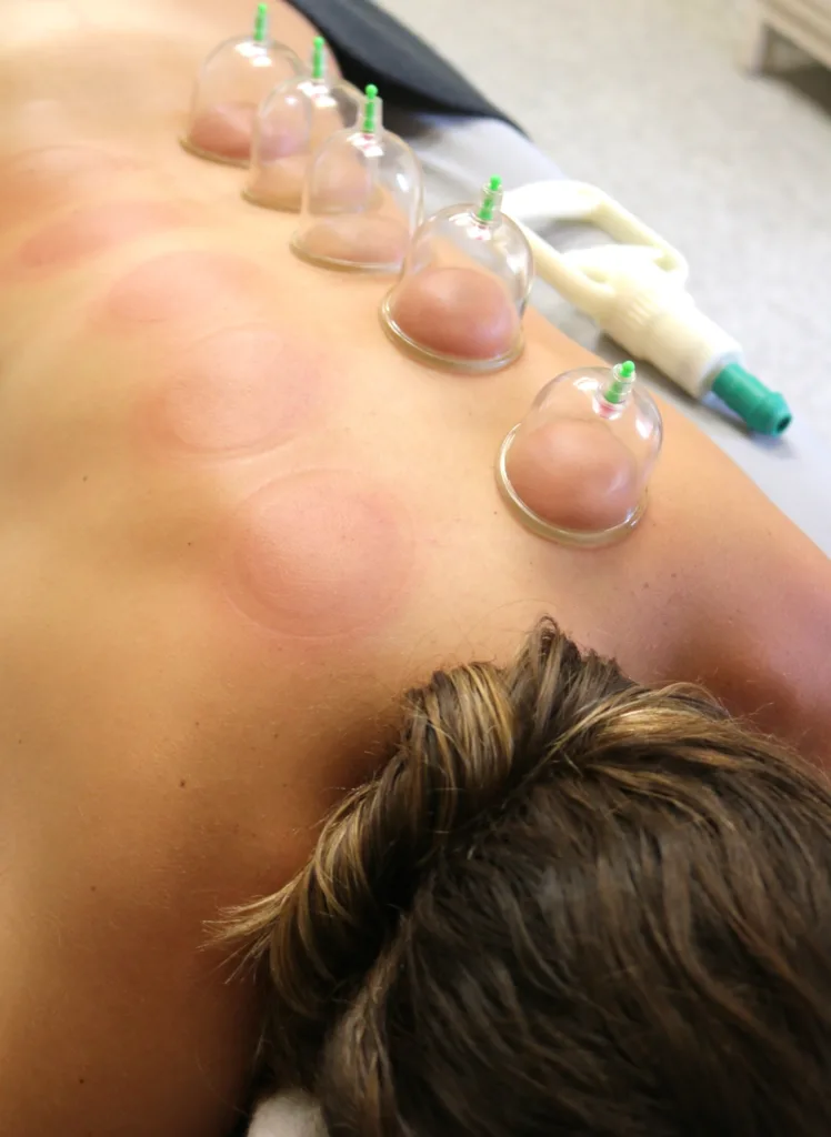 Patient receiving Cupping treatment