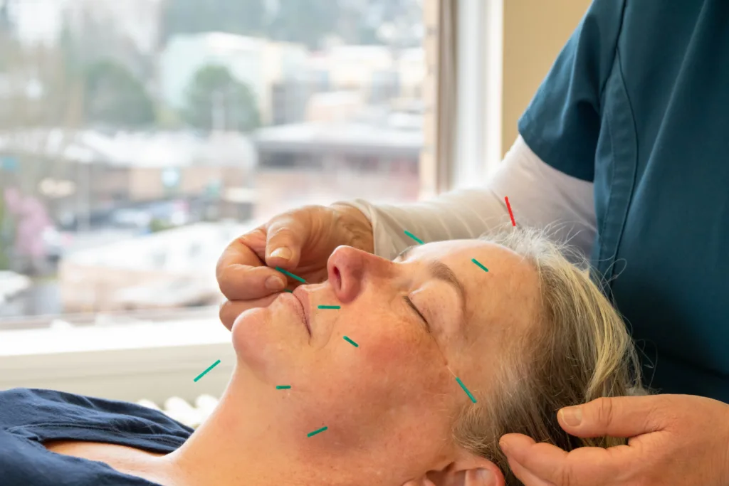 mei zen cosmetic acupuncture